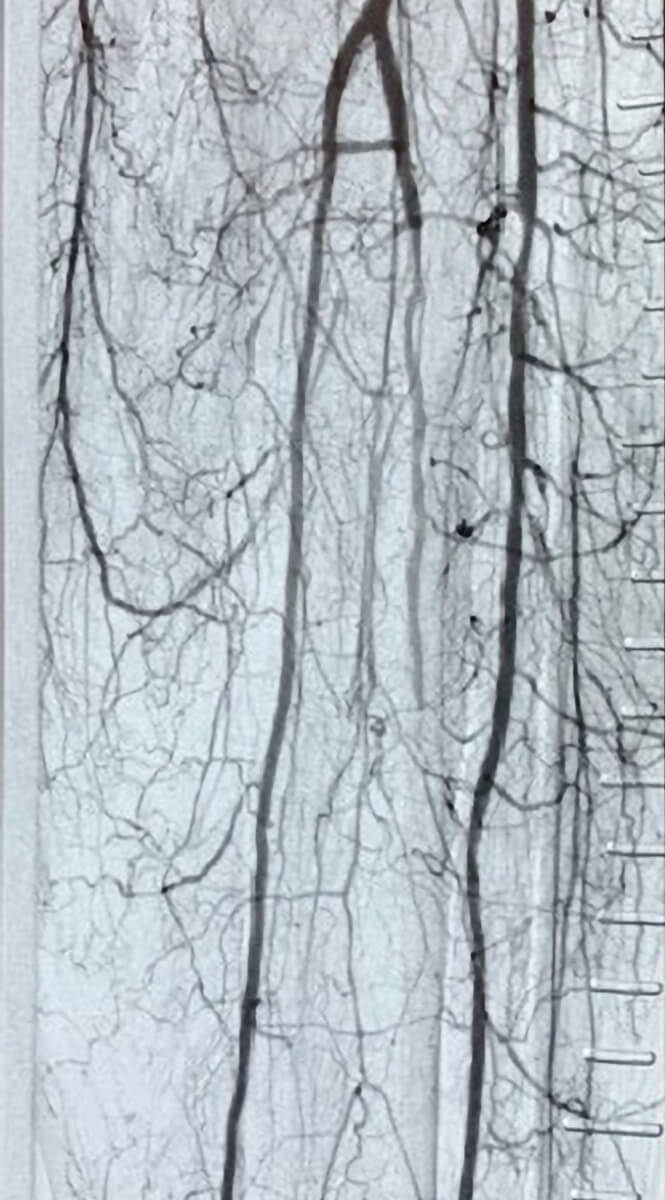 Image of infrainguinal arteries with restored patency after treatment with the Auryon System for peripheral atherectomy