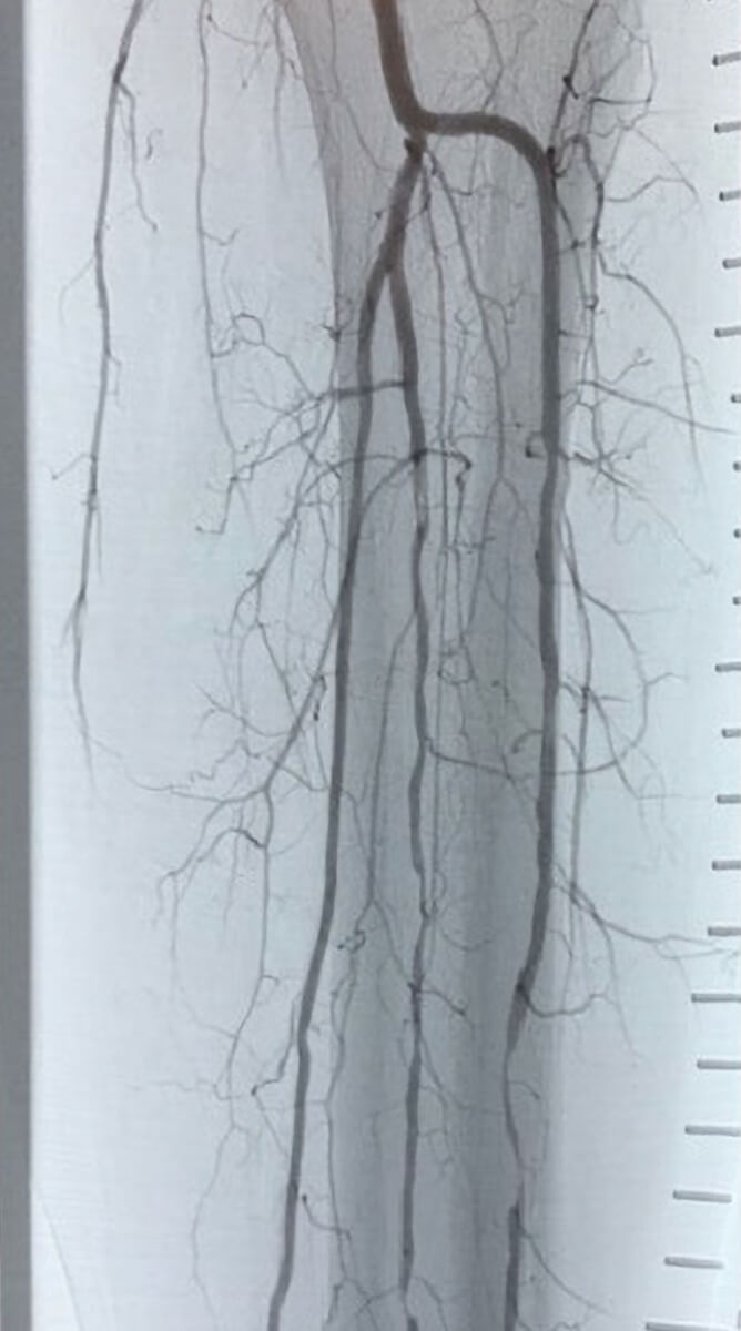 Image of occluded infrainguinal arteries before treatment with the Auryon System for peripheral atherectomy
