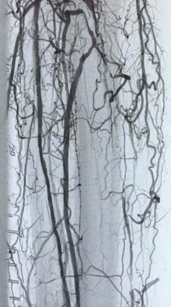 Image of infrainguinal arteries with restored patency after treatment with the Auryon PAD system