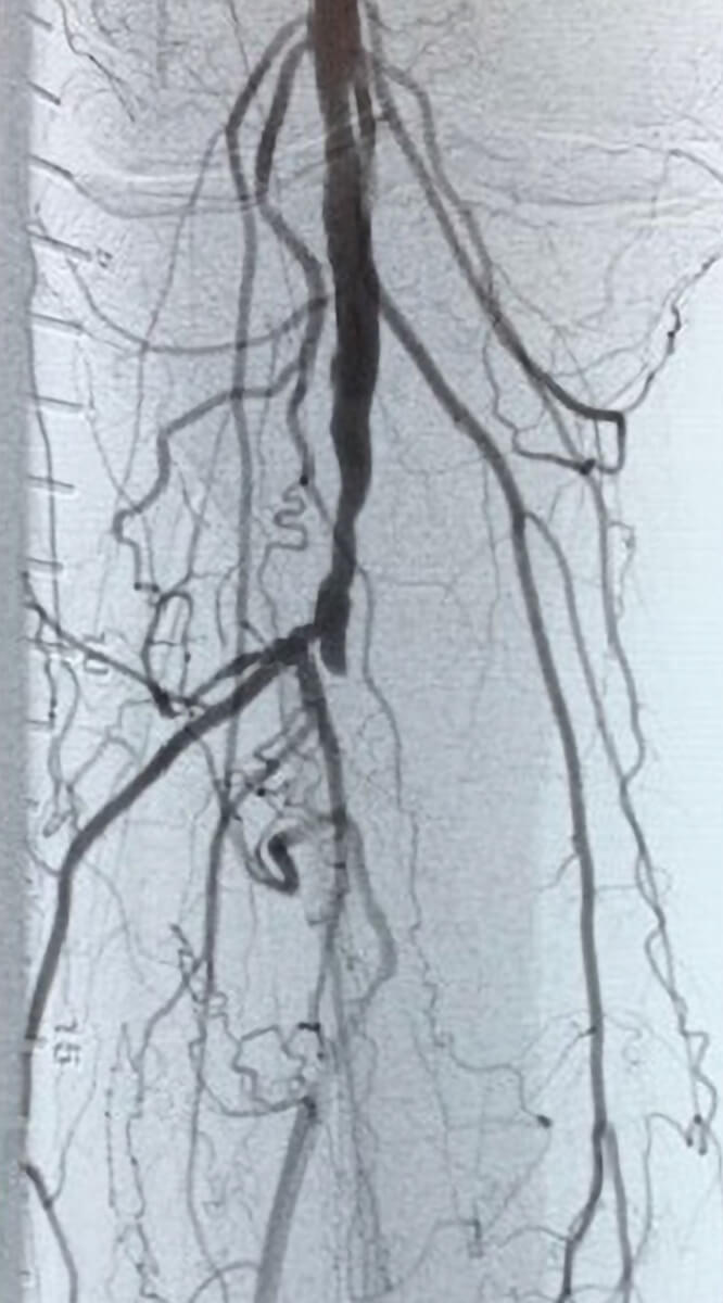 Image of occluded infrainguinal arteries before treatment with the Auryon PAD system