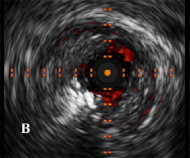IVUS IMAGE POST AURYON LASER IN THE POPLITEAL ARTERY