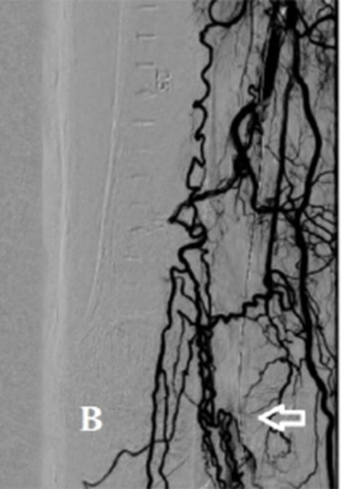 PRE AURYON LASER CTO POPLITEAL